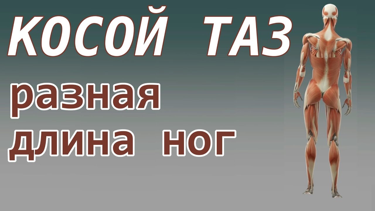 📚 Косой таз | разная длина ног (симптомы, причины и лечение) - YouTube