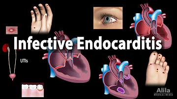 ¿Puede la endocarditis provocar un ictus?