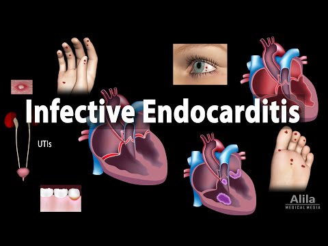 Infective Endocarditis, Animation