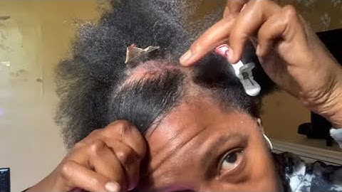 ASMR SCALP SCRATCHING ASMR BIG FLAKES Plaque Psoriasis Huge Flakes!!! #scalpscratching