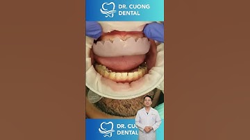 Quá Trình Làm Răng Tạm Sẽ Như Thế Nào ?| Bác sĩ Cường