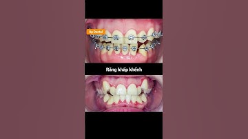 Cận cảnh quá trình thay đổi răng khấp khểnh mức độ 2