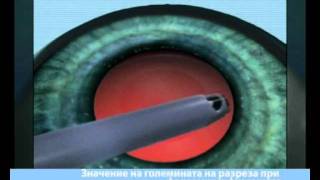 Описание На Катаракта