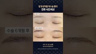 절개 쌍꺼풀 재수술 흉터 전후 비교💖 #절개쌍꺼풀