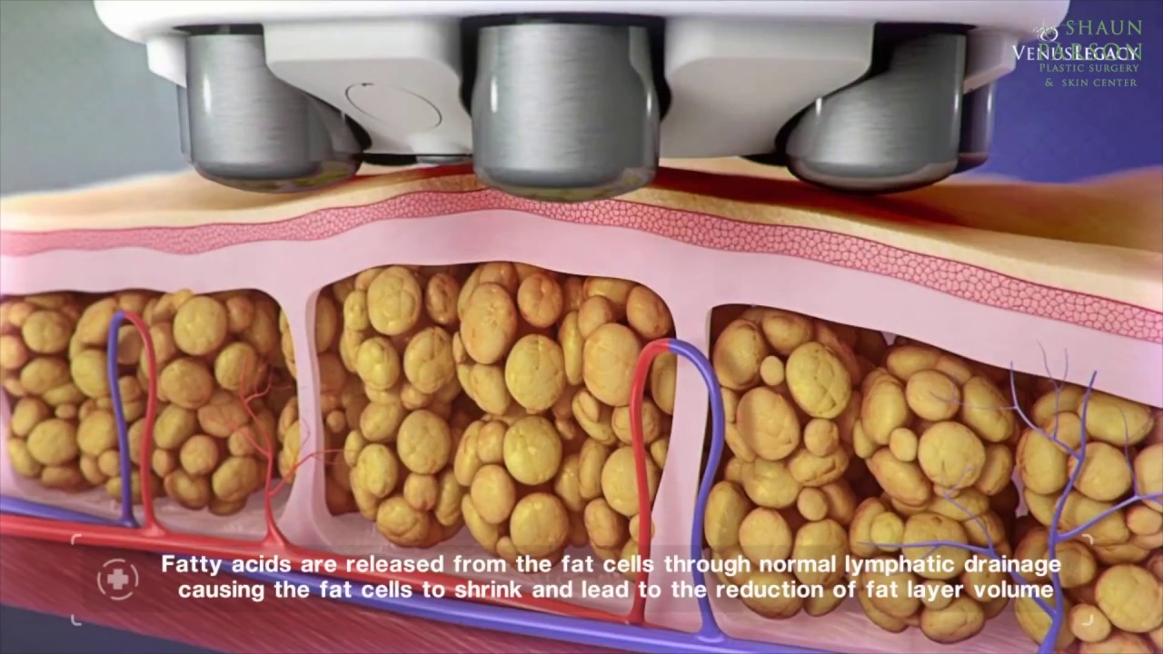 Venus Legacy Skin Tightening & Fat Reduction Treatment