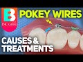 Pokey Wire / Braces Pain: Causes and Fixes