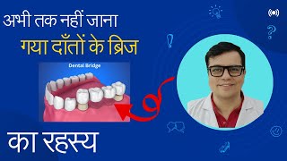 डेंटल ब्रिज का खोजी रहस्य. Everything You Need to Know About Dental Bridges