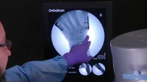 Surgical Approach to Rolando Fractures with Asif M Ilyas, MD