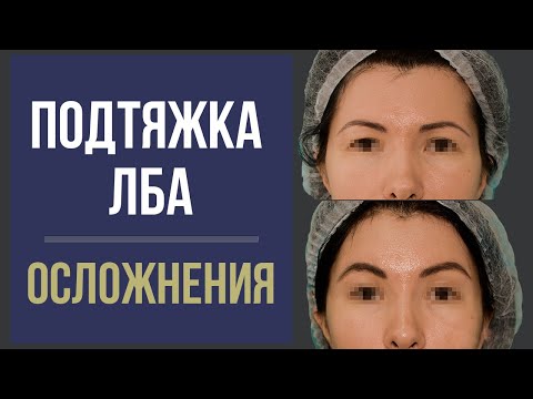 ЭНДОСКОПИЧЕСКАЯ ПОДТЯЖКА ЛБА И БРОВЕЙ 😯 ОСЛОЖНЕНИЯ ⛔