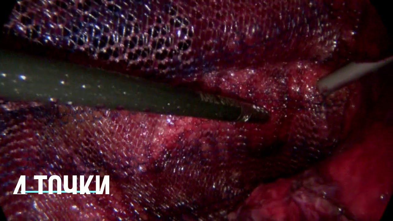 TAPP bilateral video editing software free