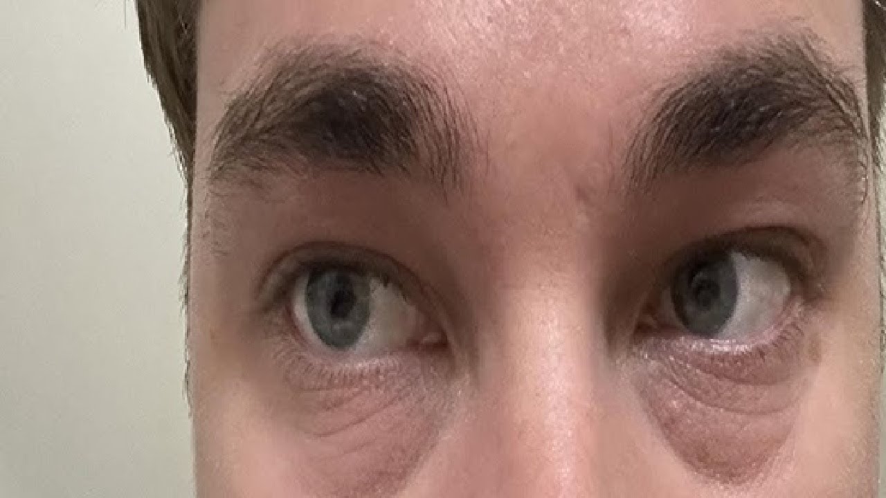 HOW TO GET RID OF BAGS UNDER YOUR EYES BEST WAY - YouTube