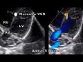 Types of vsd echocardiography
