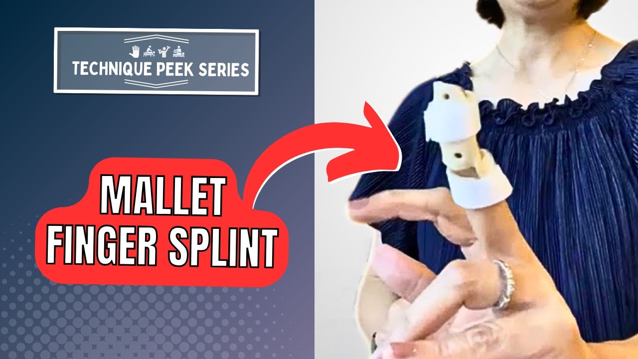 How To Make a Mallet Finger Splint  |  Technique Peek Series