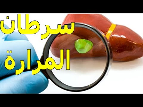 سرطان المرارة | معلومات هامة حول هذا المرض