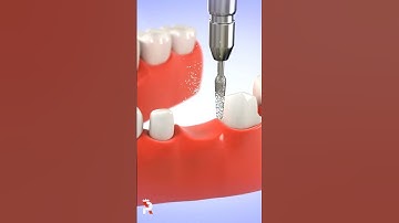 Repairing Damage To Front Teeth 3D animation #3d #3danimation #princeraihan