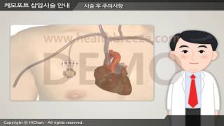 [시연용] c0003aako 케모포트 삽입 시술