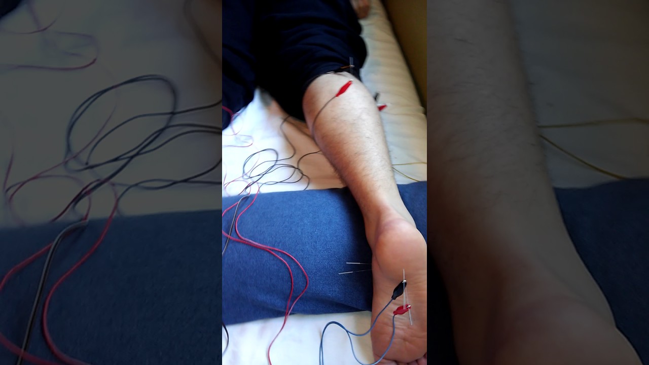 Acupuncture for Plantar Fasciitis part 1 YouTube