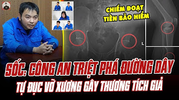 SỐC: CÔNG AN TRIỆT PHÁ ĐƯỜNG DÂY TỰ ĐỤC VỠ XƯƠNG GÂY THƯƠNG TÍCH GIẢ NHẰM CHIẾM ĐOẠT TIỀN BẢO HIỂM