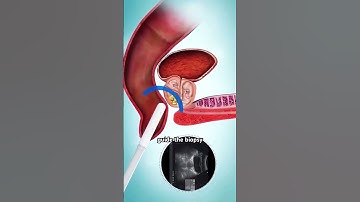 How Transperineal Prostate Biopsy Procedure Is Performed?(3D Animation) #prostatitis #peritoneal