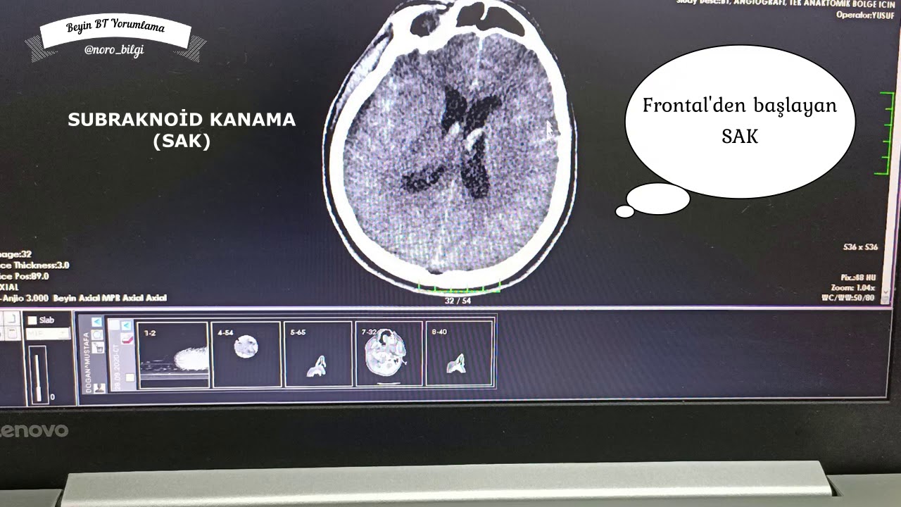 NONTRAVMATİK HASTADA BEYİN BİLGİSAYARLI TOMOGRAFİ (BT) YORUMLAMA  (norobilgi)