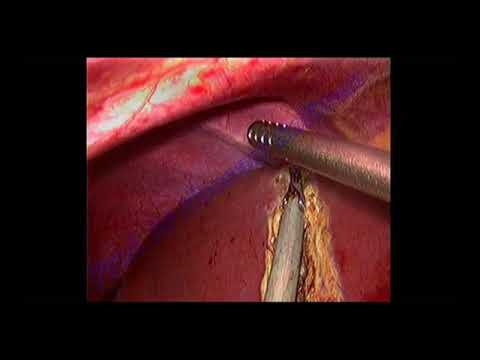 Laparoscopic Right hepatectomy for huge hemangioma using anterior approach by Prof. Hossam Soliman