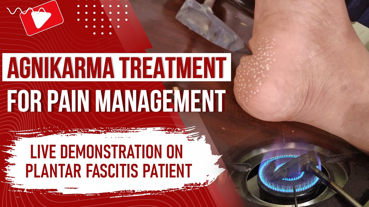 Agnikarma treatment by Dr. Raman Ranjan | Live demonstration on Plantar Fascitis patient
