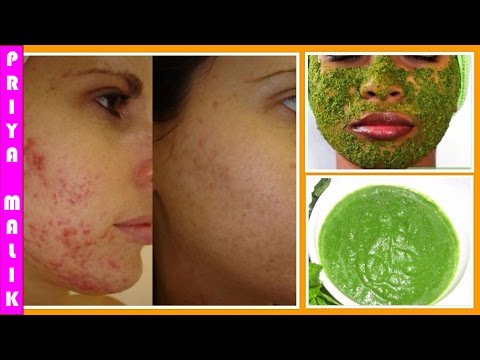 How To Get Rid Of Acne Naturally || Neem Face Pack || Neem Acne Treatment