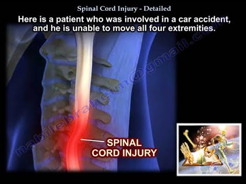 Spinal Cord Injury, Detailed  - Everything You Need To Know - Dr. Nabil Ebraheim