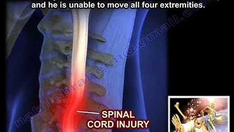 Spinal Cord Injury, Detailed  - Everything You Need To Know - Dr. Nabil Ebraheim