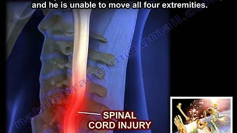 Spinal Cord Injury, Detailed  - Everything You Need To Know - Dr. Nabil Ebraheim