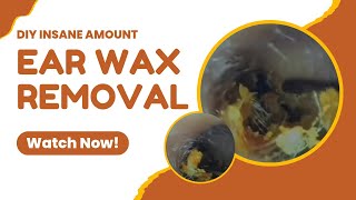 This satisfying ear cleaning session shows tons of ear wax being removed safely and gently. 
