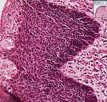 Histopathology Penis--Erythroplasia of Queyrat