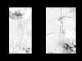Endovascular treatment of a spinal dural arteriovenous malformation (DAVF)