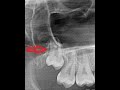 Upper wisdom impacted 3rd molar with enlarged follicular space removal