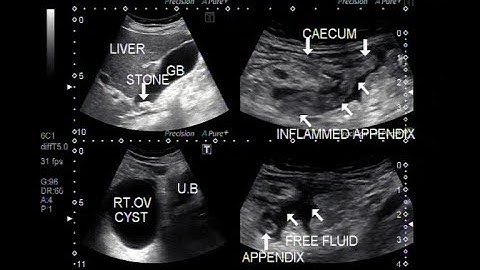 Ultrasound Video showing inflamed appendix, Right ovarian cyst and a stone in gall bladder.