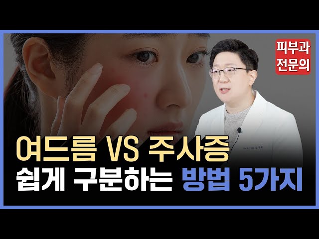 피부에 생긴 트러블, 단순 여드름인 줄 아셨죠? ... 하지만 만성홍조라면?! (여드름VS주사증)