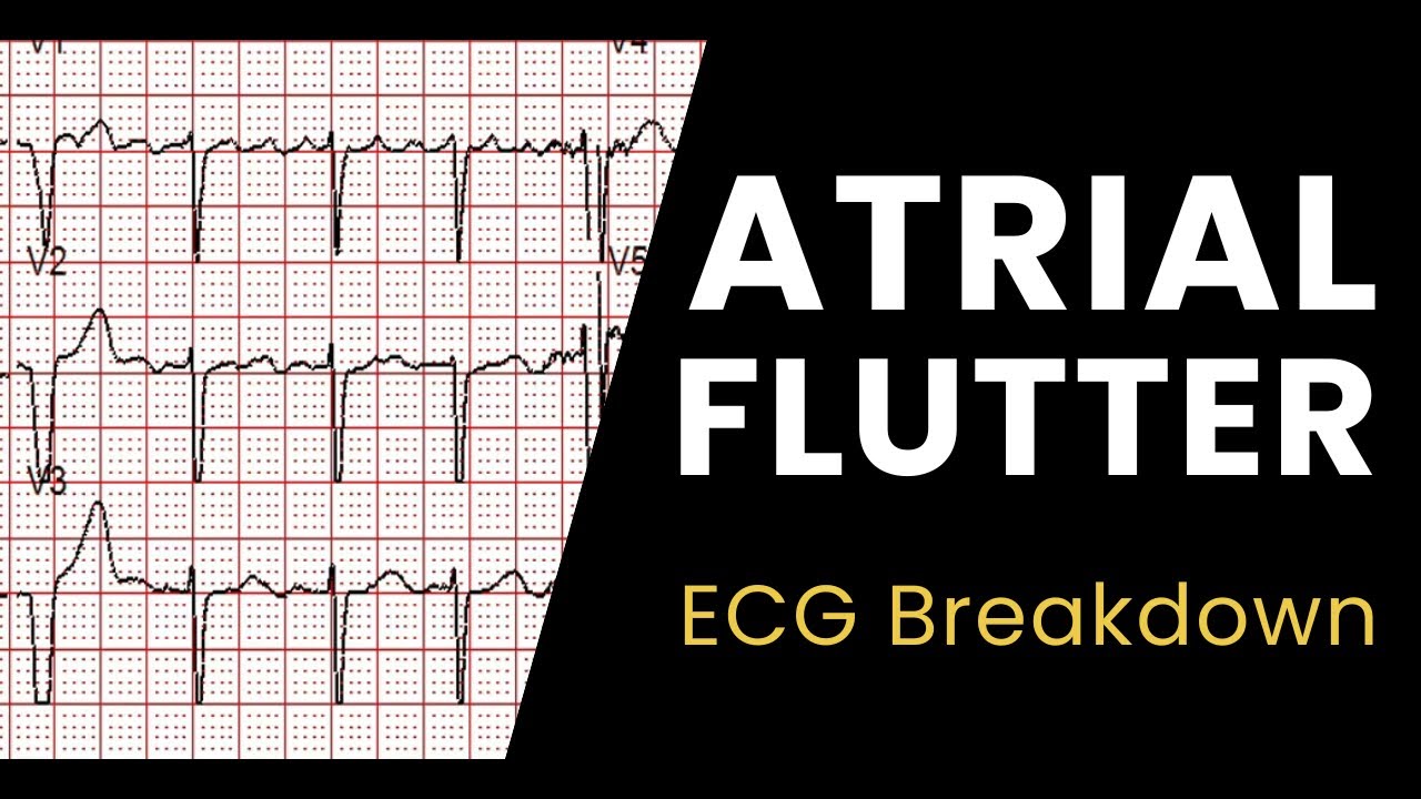 Atrial Flutter Zero To Finals