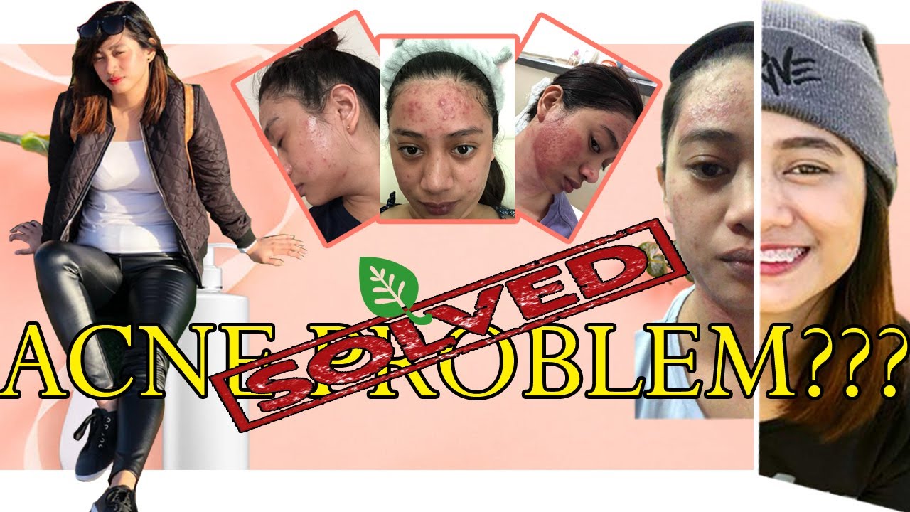 clear-your-acne-in-2-weeks-most-effective-skin-care-supplements