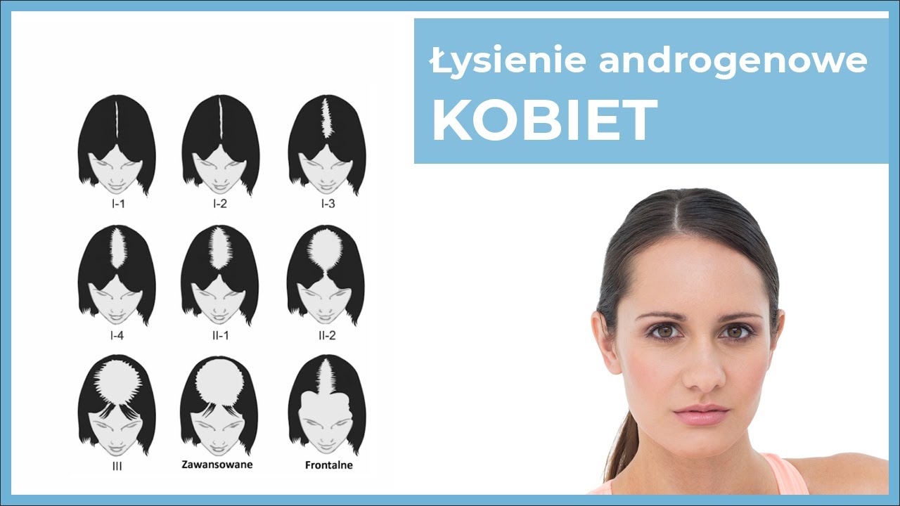 ysienie Androgenowe Kobiet YouTube ysienie-androgenowe-kobiet-youtube