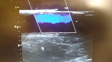 vascular phantom doppler venous