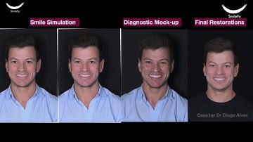 How to create an upper and lower in-office 3D Smile design for your patients with Smilefy (Part 1)