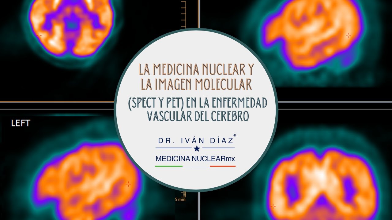 LA MEDICINA NUCLEAR Y LA IMAGEN MOLECULAR (spect y pet) EN LA ENFERMEDAD VASCULAR DEL CEREBRO