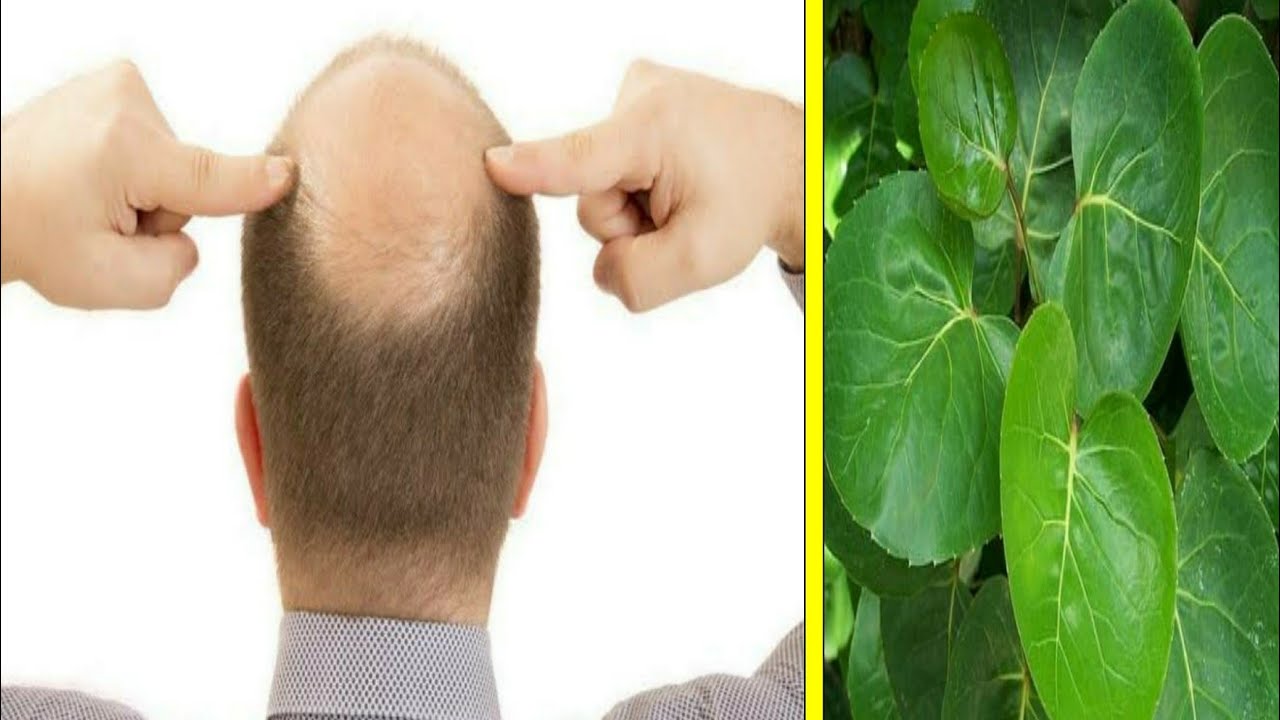  Cara  Mengatasi Kebotakan dan Rambut  Rontok Dengan  Bahan  