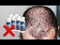 Don't Use MINOXIDIL Before Watching This! – It Does NOT Prevent Hair Loss