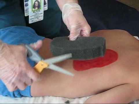wound vac demonstration youtube
