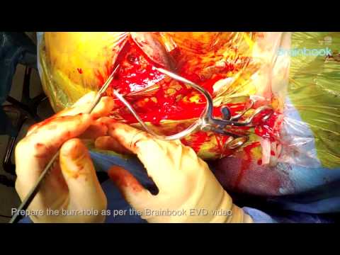 Ventriculo-peritoneal shunt - GoPro footage
