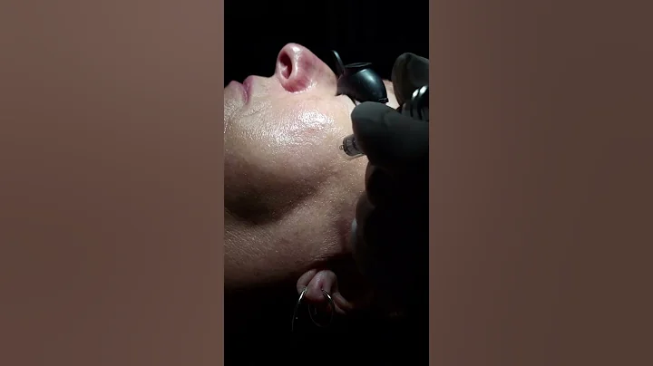 Treating Hyperpigmentatio...  with Micro-needling