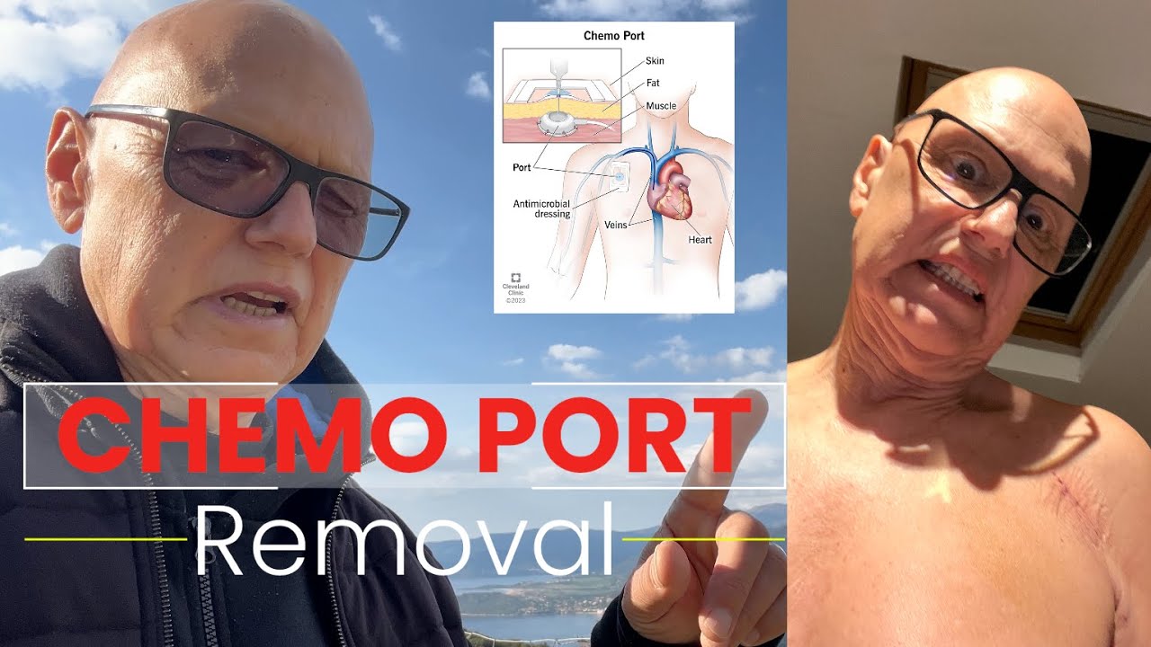 Chemo Port Removal And Update Youtube 