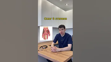 Что нужно знать про ожоги. Доктор Садыков