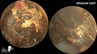 1,677 - Wax Plug & Dead Skin Extraction | Endoscopic Ear Wax Removal